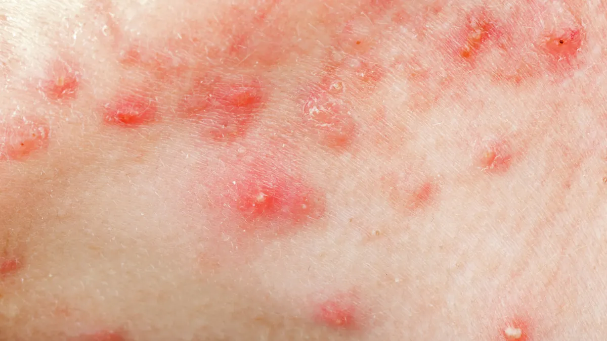 Acne Cística: Causas, Tratamentos e Como Prevenir Cicatrizes