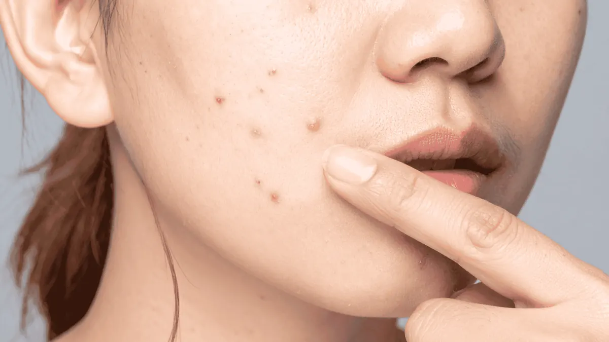 Acne Hormonal: Causas, Diagnóstico e Tratamento na Mulher Adulta