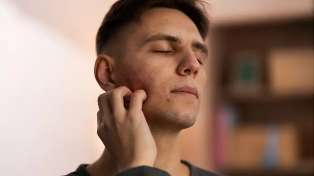 Acne na Vida Adulta: Causas, Tratamentos e Cuidados Essenciais para uma Pele Saudável
