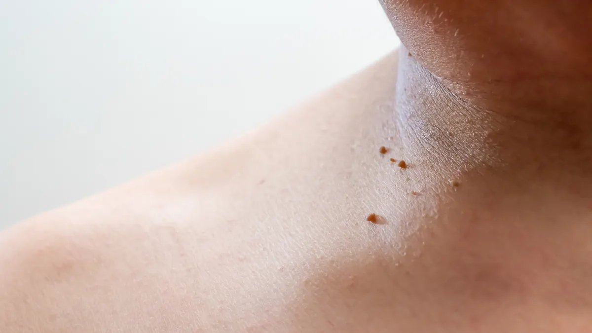 Acrocórdons (Fibromas Moles): O Que São, Causas e Como Remover