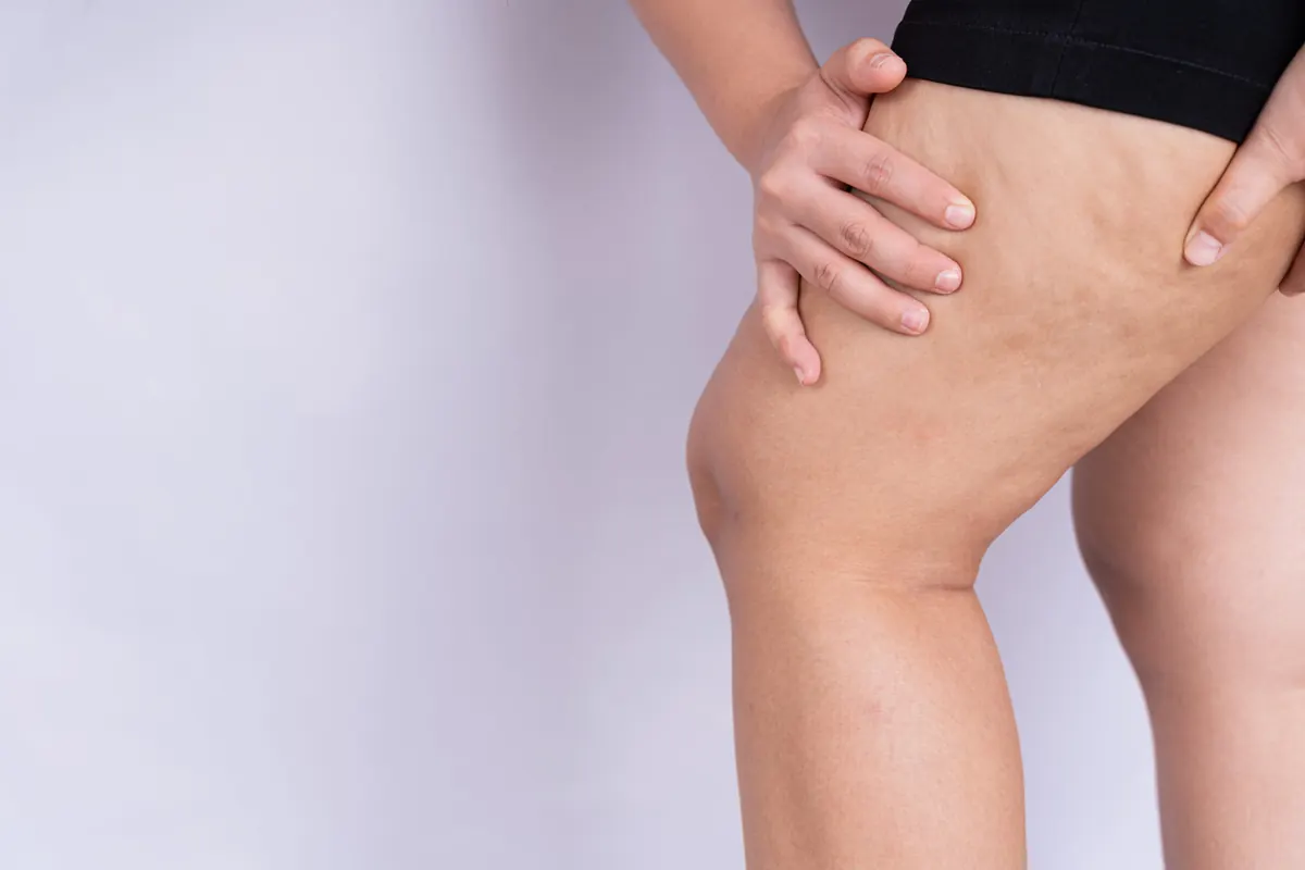 Celulite: Causas, Graus e Tratamentos Dermatológicos Mais Eficazes