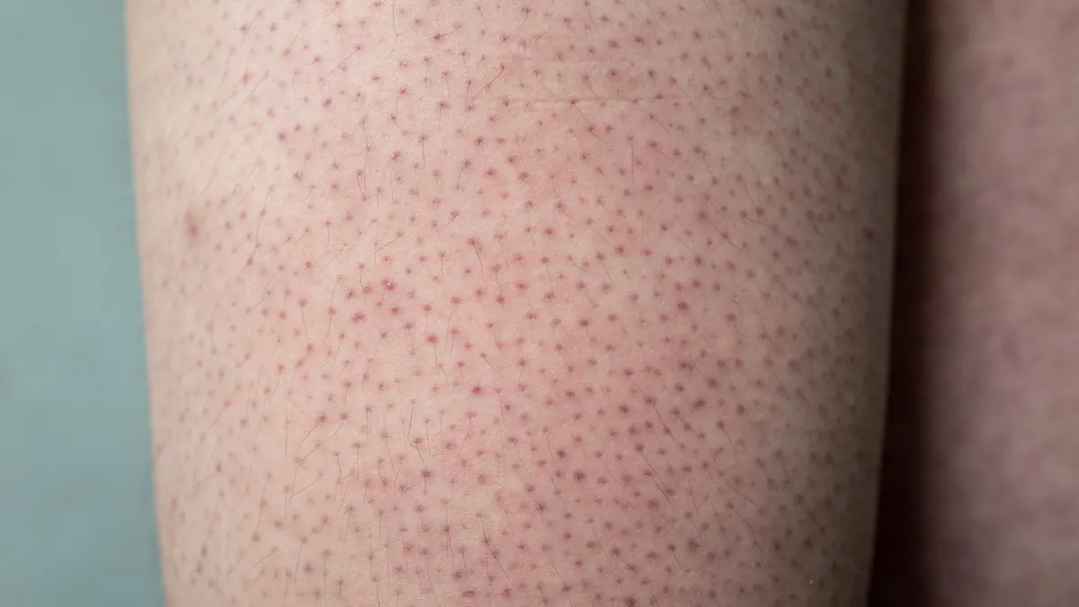 Ceratose Pilar: O Que São Aquelas Bolinhas nos Braços e Como Tratar