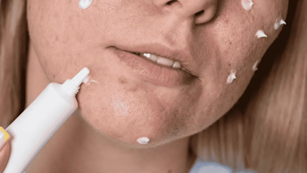Cicatrizes De Acne: Estratégias Para Uma Pele Lisa
