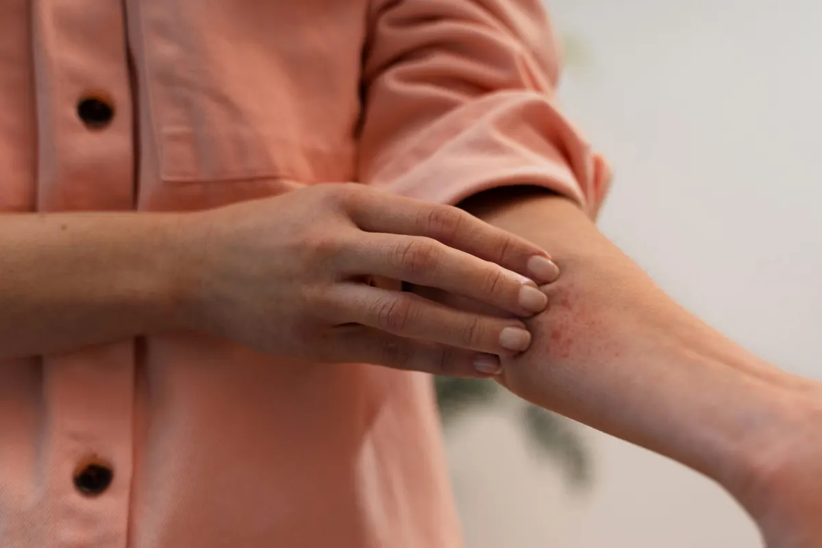 Dermatite Atópica: Causas, Sintomas e Tratamentos Modernos