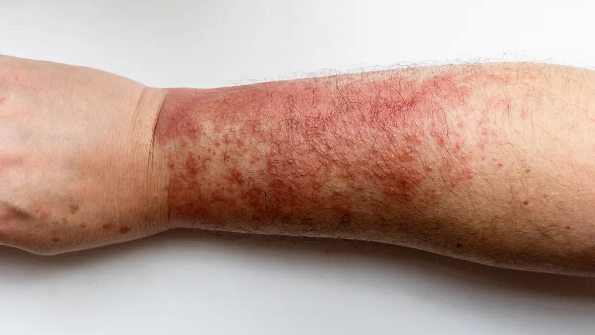 Dermatite de Contato: Tipos, Causas, Diagnóstico e Tratamento