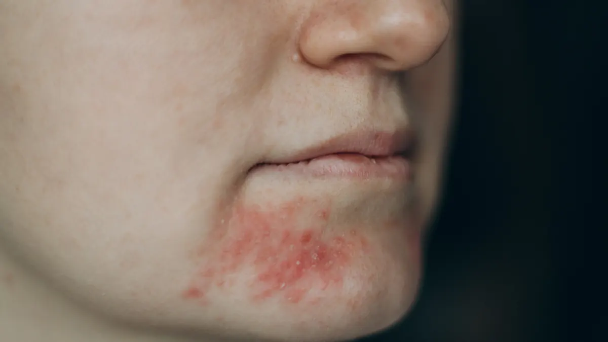 Dermite Perioral: Causas, Sintomas e Tratamento Dermatológico