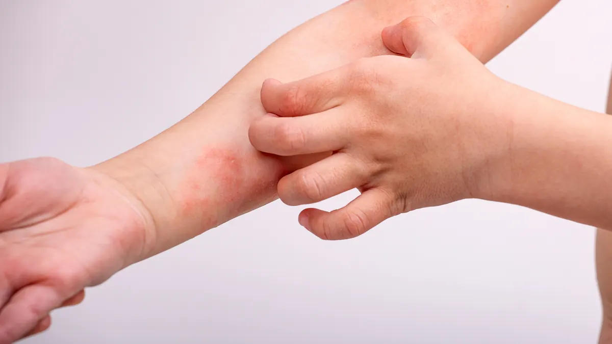 Eczema Numular: Causas, Sintomas e Tratamento Dermatológico Eficaz