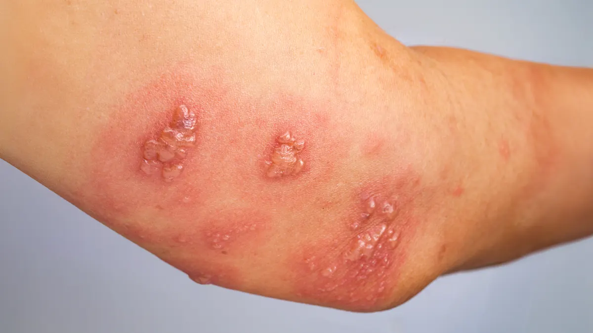 Escabiose (Sarna): 5 Sintomas, Diagnóstico e Tratamento Dermatológico