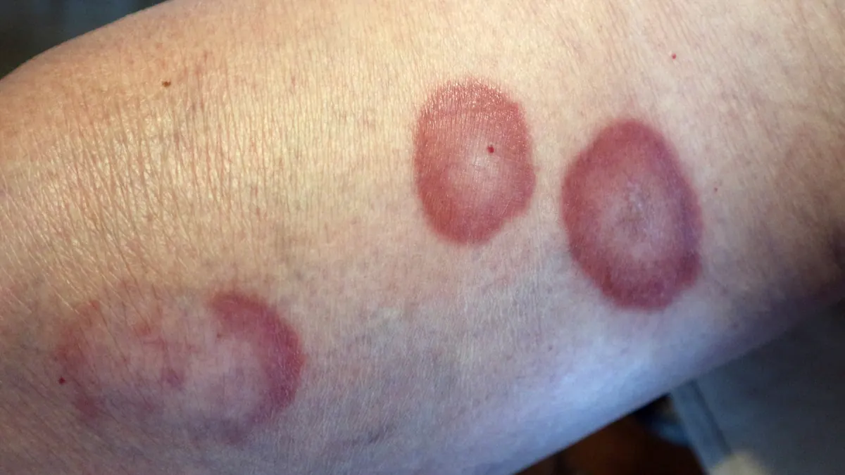 Granuloma Anular: O Que É, Tipos, Causas e Tratamento Dermatológico