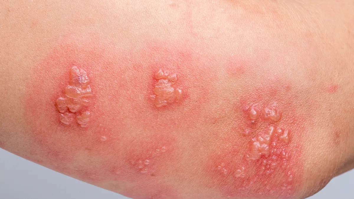 Herpes Zoster (Cobreiro): Sintomas, Tratamento e Como Prevenir