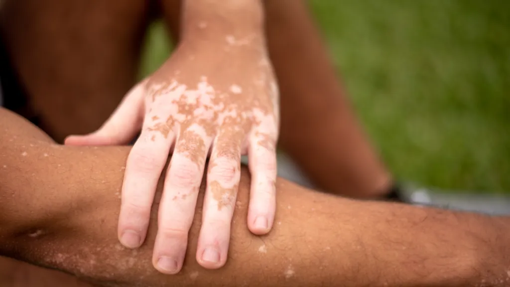 Vitiligo | Dra. Raisa Resende