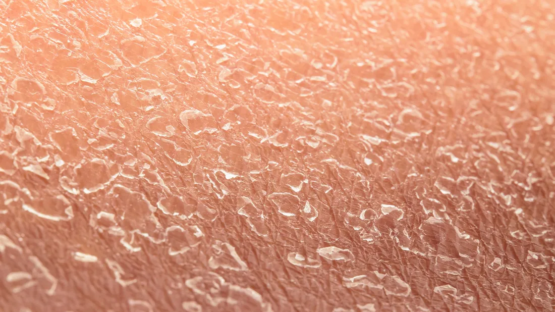 Dermatoscopia - exame dermatológico