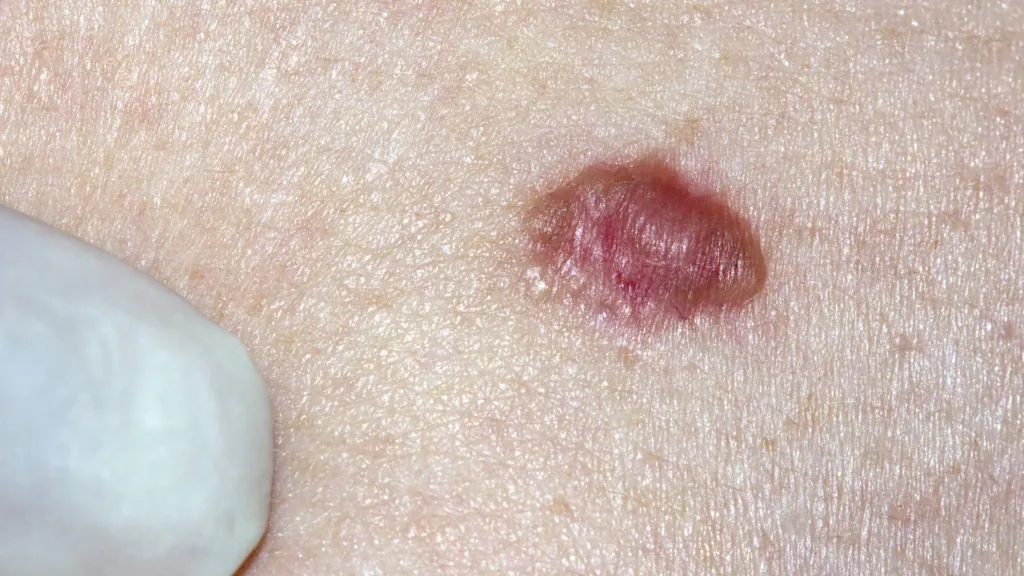 Carcinoma Basocelular | Dra. Raisa Resende