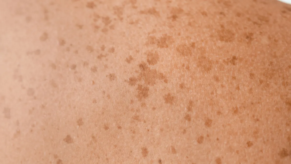 Lentigo Solar: Manchas de Sol na Pele, Causas, Diagnóstico e Tratamento