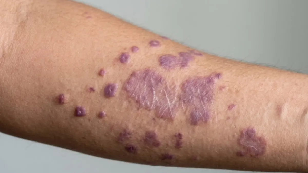 Líquen Plano: Tipos, Causas, Sintomas e Tratamentos Dermatológicos