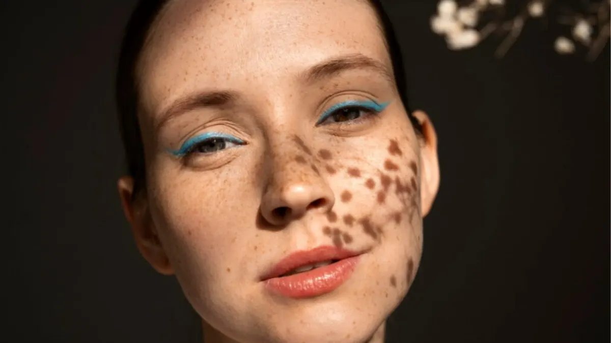 Manchas na Pele: Diferença Entre Melasma, Lentigo e Hiperpigmentação Pós-Inflamatória