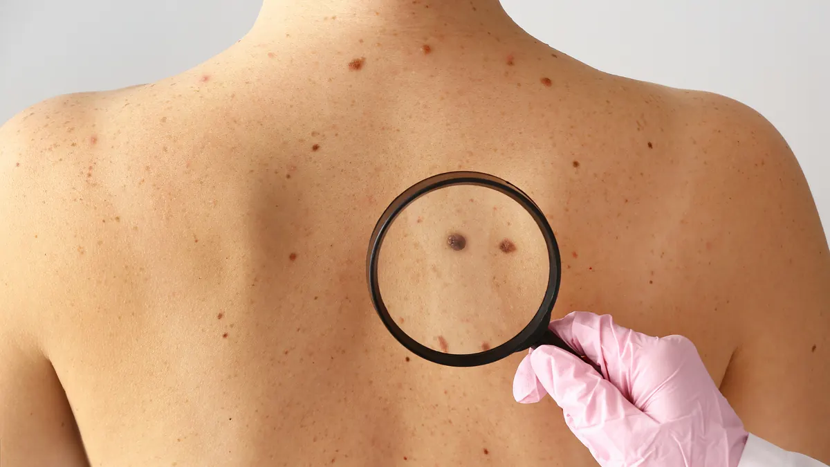 Melanoma: 5 Sinais de Alerta, Fatores de Risco e Como Prevenir