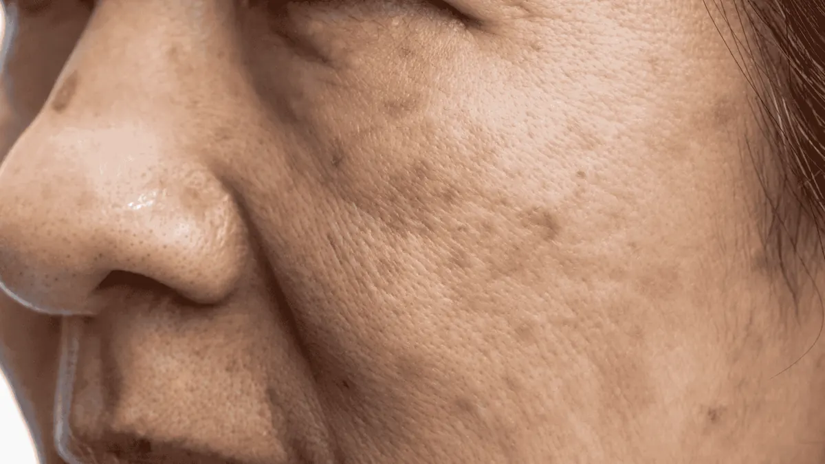 Melasma: O Guia Completo para o Tratamento e Controle de Manchas