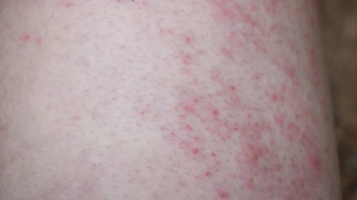 Miliária (Brotoeja): Causas, Tipos, Sintomas e Tratamento Dermatológico