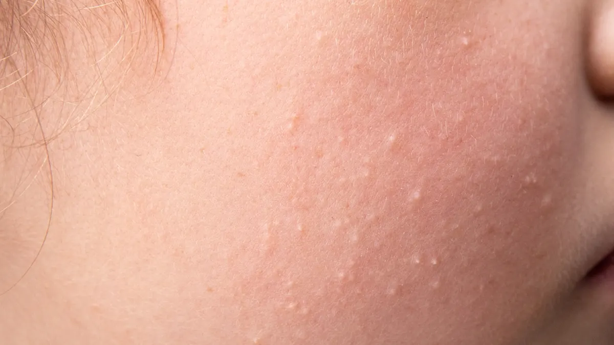 Milium: O Que São os Grãos de Milho na Pele e Como Remover