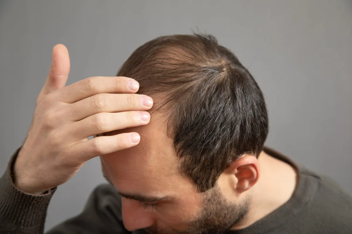 O Que é Alopecia? Causas, Tipos e Tratamentos