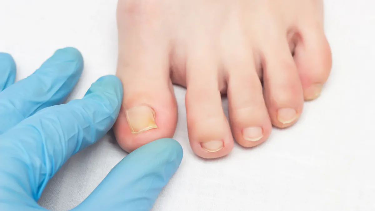 Onicocriptose (Unha Encravada): Causas, Sintomas e Tratamento
