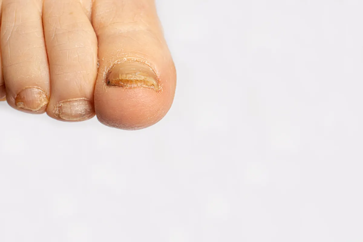 Onicomicose: Micose nas Unhas, Causas, Sintomas e Tratamento