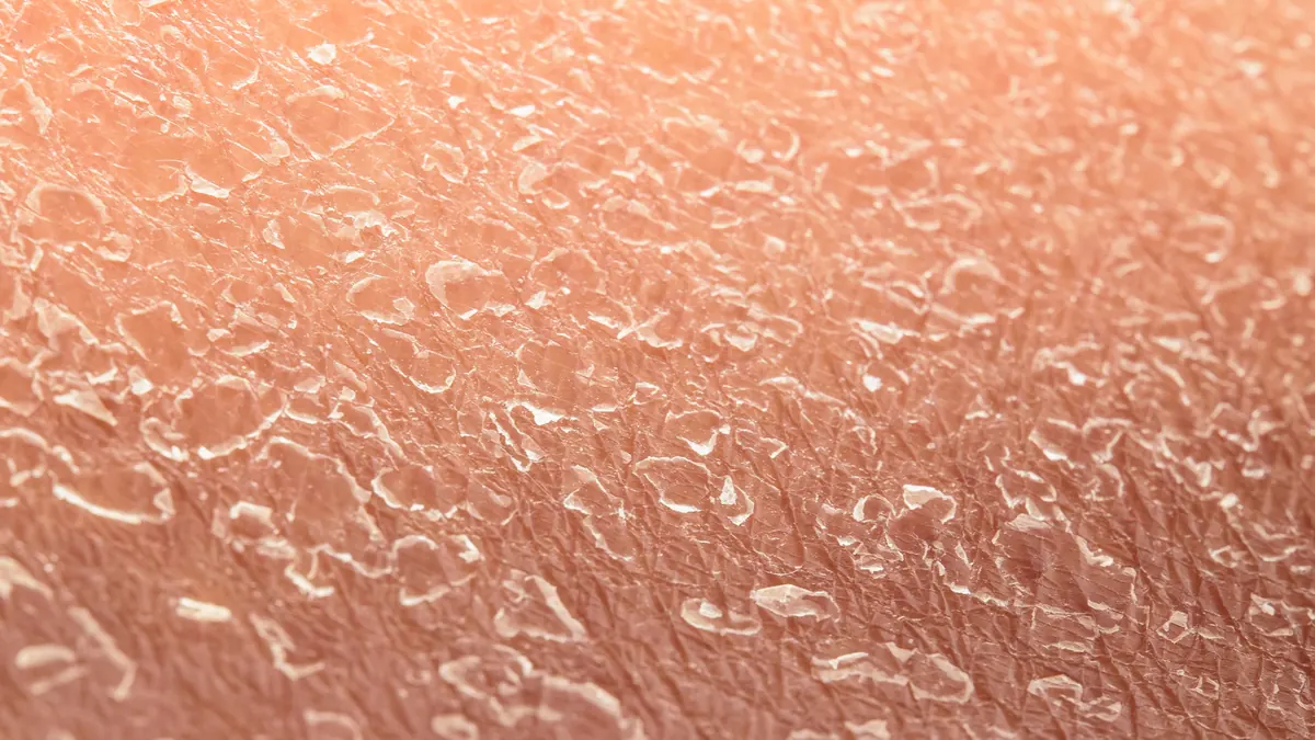 Pele Seca (Xerose): Causas, Sintomas e Tratamento Dermatológico