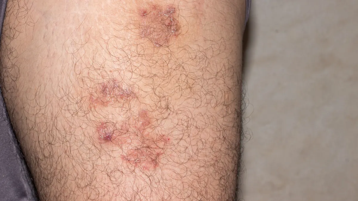 Pênfigo Vulgar: Causas, Sintomas, Diagnóstico e Tratamento Dermatológico