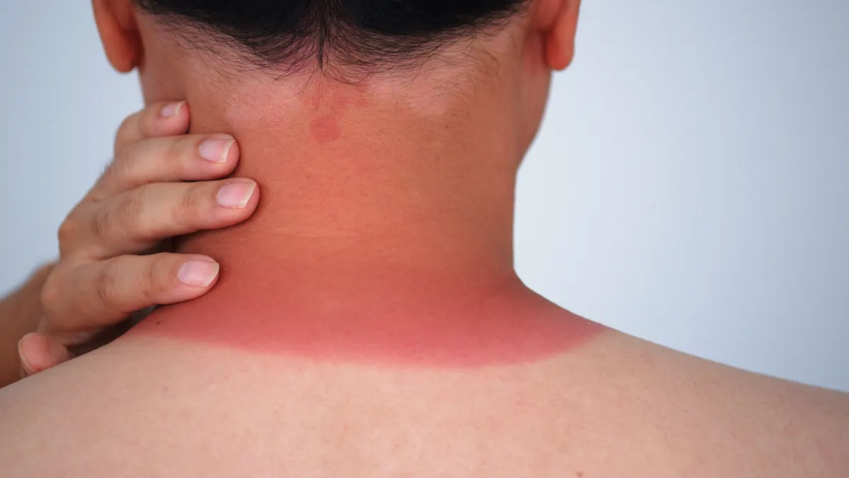 Queimadura Solar: Graus, Sintomas, Tratamento e Como Prevenir