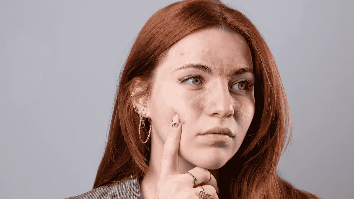 Rosácea: Manejo Clínico, Dieta e Laser Vascular