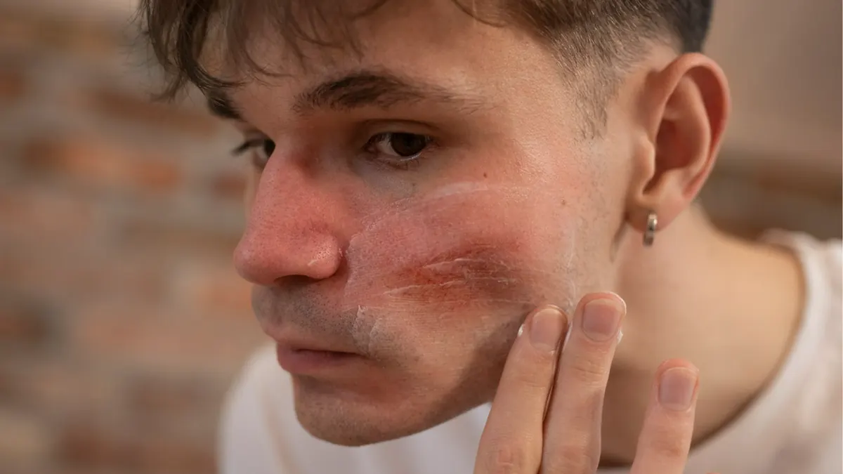 Rosácea: Sintomas, Gatilhos e Tratamentos Dermatológicos Modernos