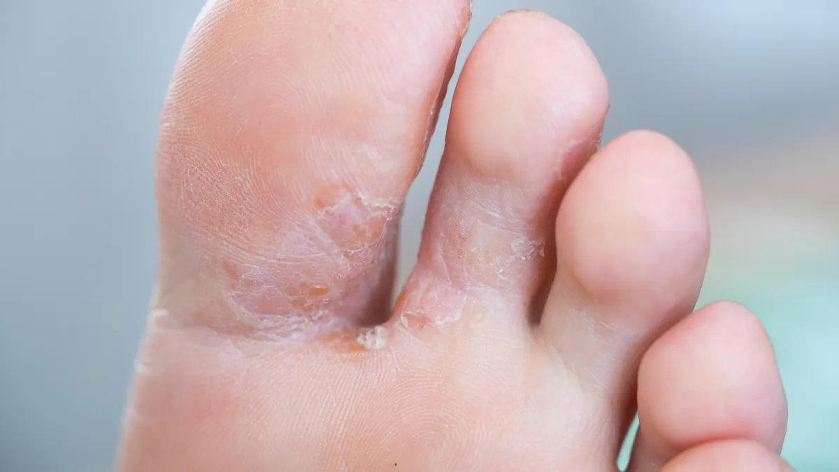Tinha Pedis (Pé de Atleta): Causas, Sintomas e Tratamento Dermatológico