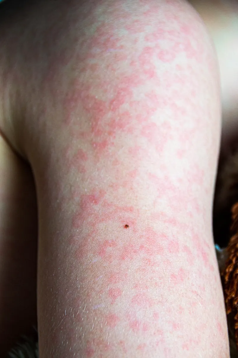 Urticária Crônica: Causas, Sintomas e Tratamento Dermatológico