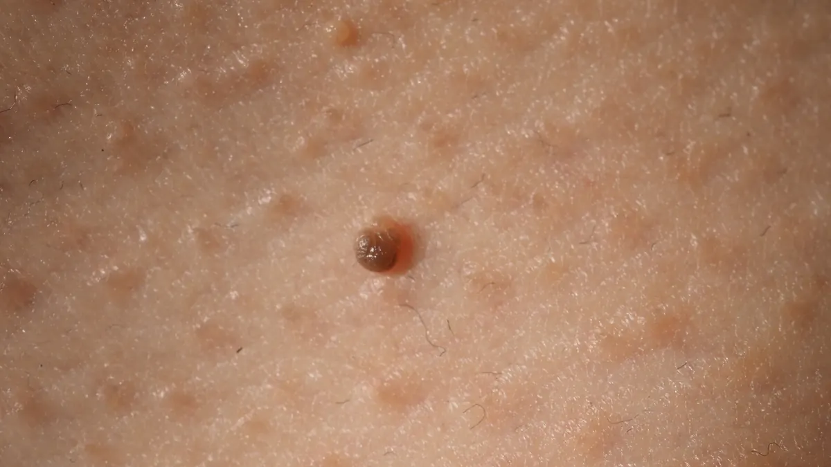 Verrugas: Tipos, Causas e Tratamentos Dermatológicos Eficazes