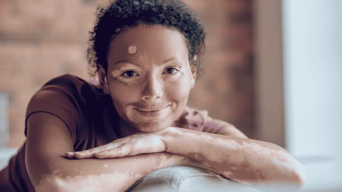 Vitiligo: Diagnóstico, Focos e Tratamentos