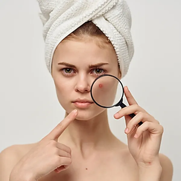 Tratamento de Acne — Dra. Raisa Resende