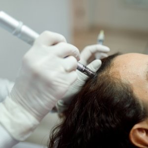 Microneedling Capilar | Dra. Raisa Resende | Dermatologia