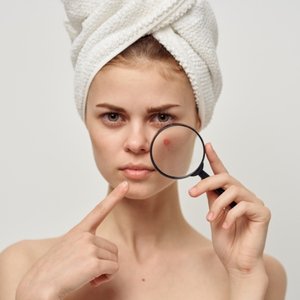 Tratamento de Acne | Dra. Raisa Resende | Dermatologista
