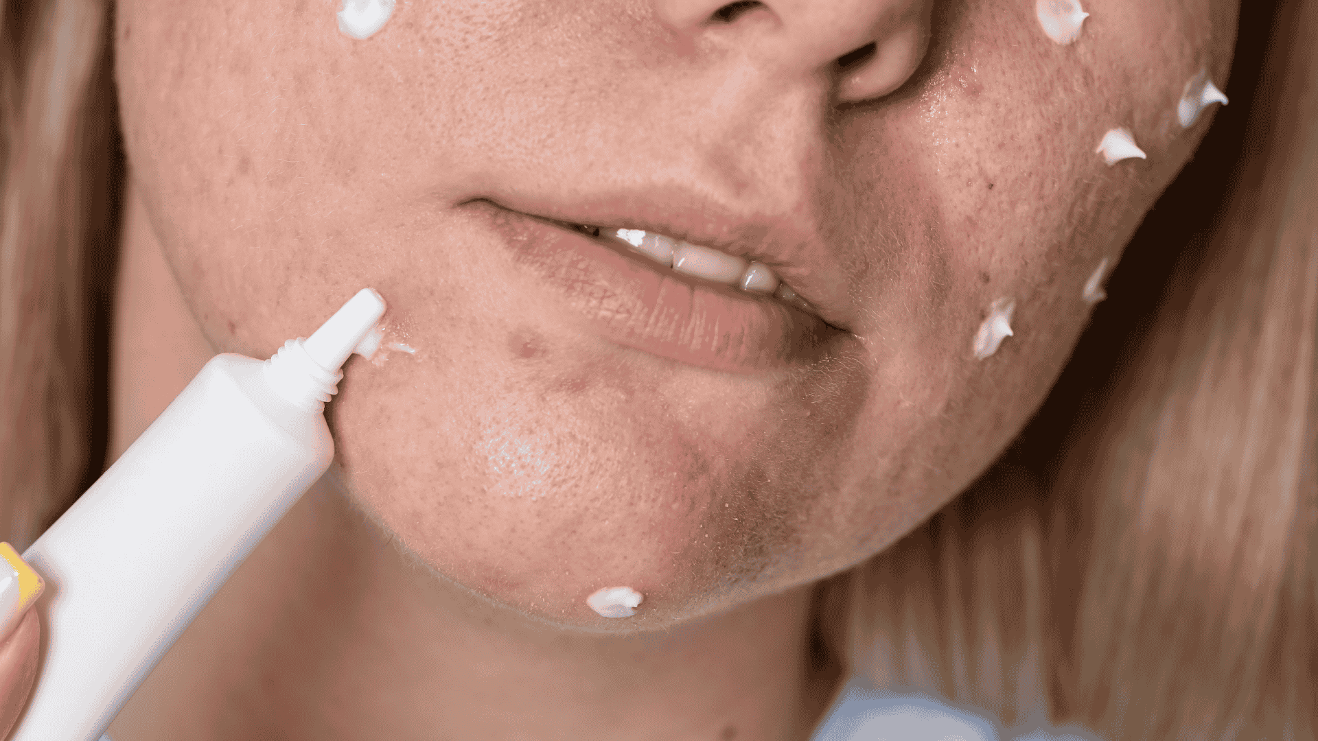 Cicatriz de Acne | Dra. Raisa Resende | Dermatologia