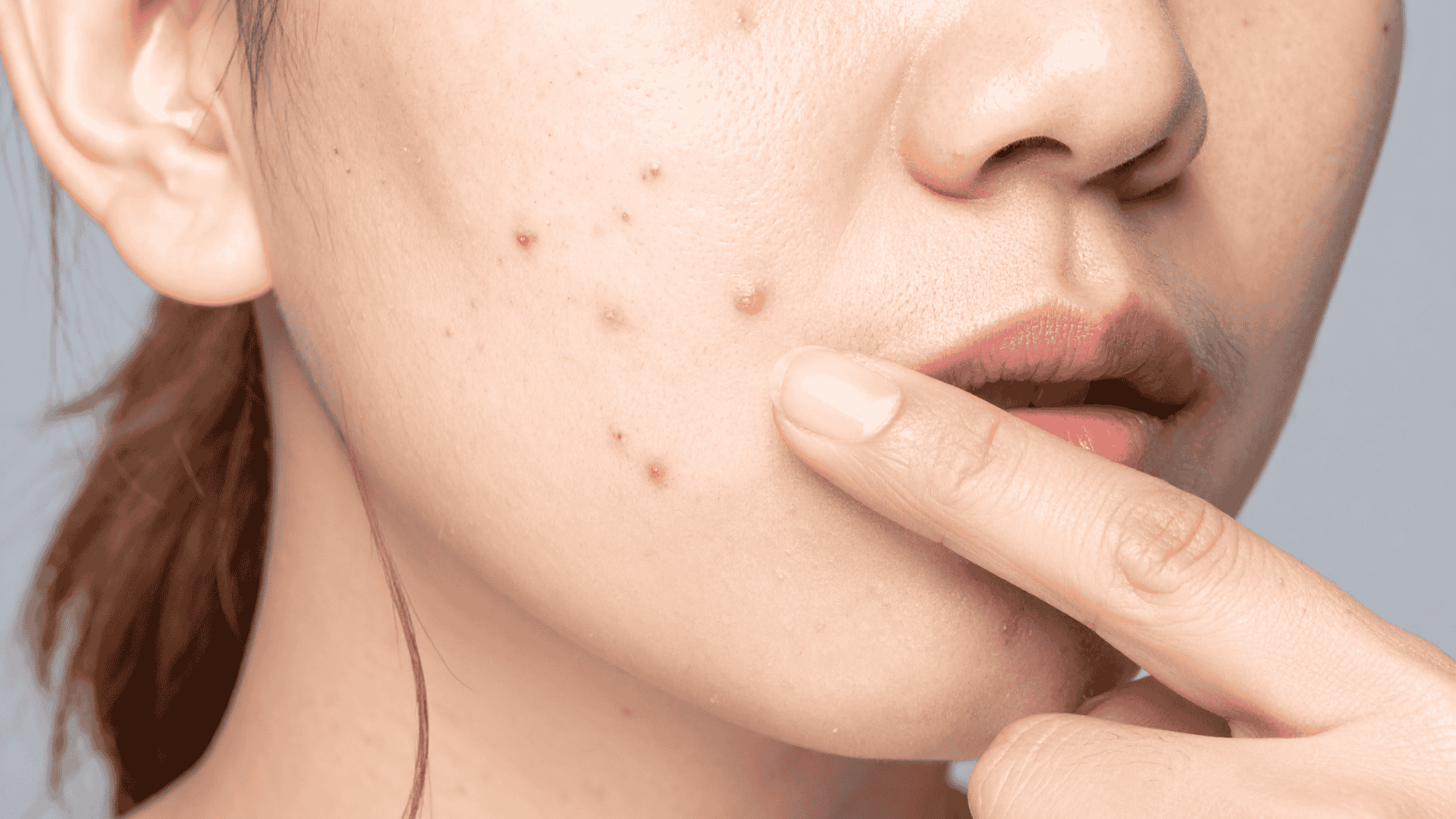 Acne Hormonal | Dra. Raisa Resende | Dermatologia