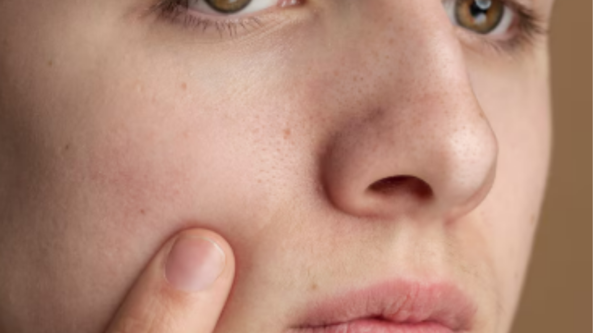 Poros Dilatados | Dra. Raisa Resende