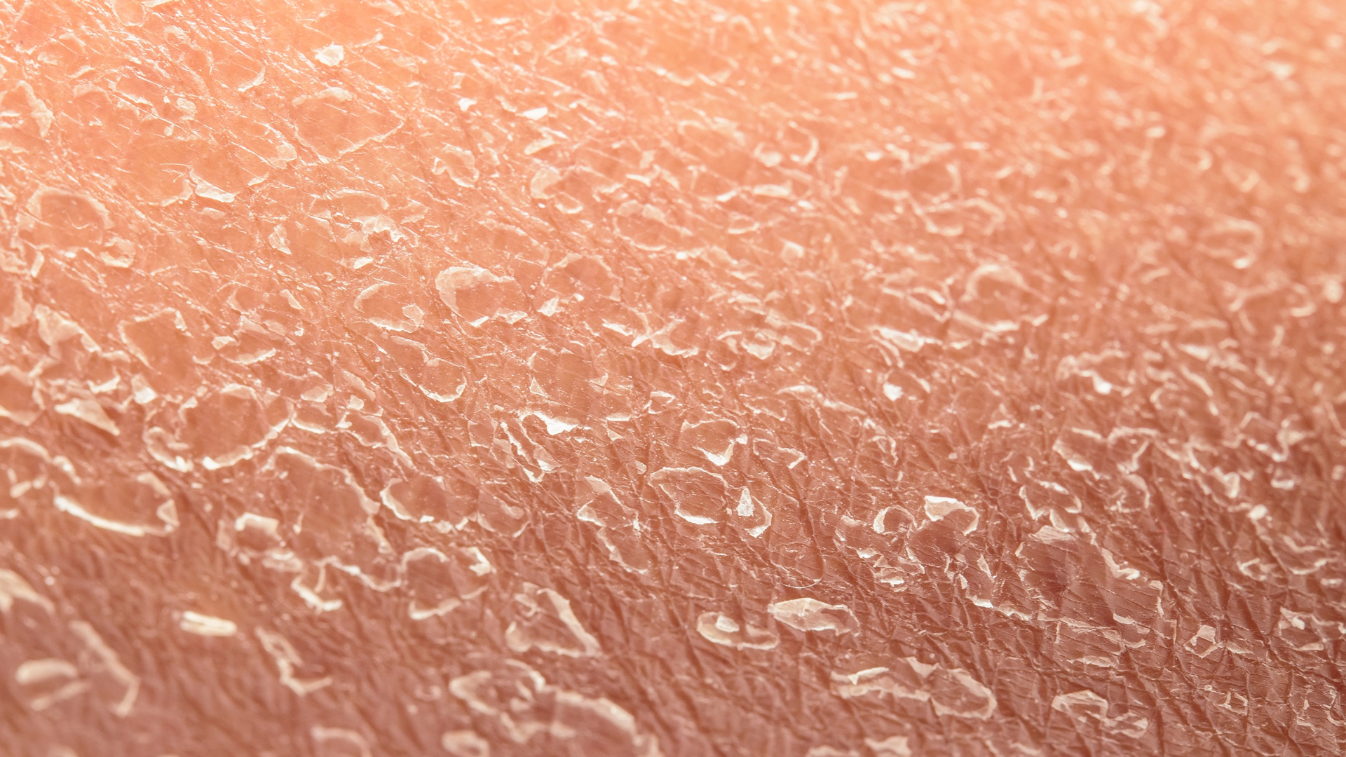 Dermatoscopia - exame dermatológico