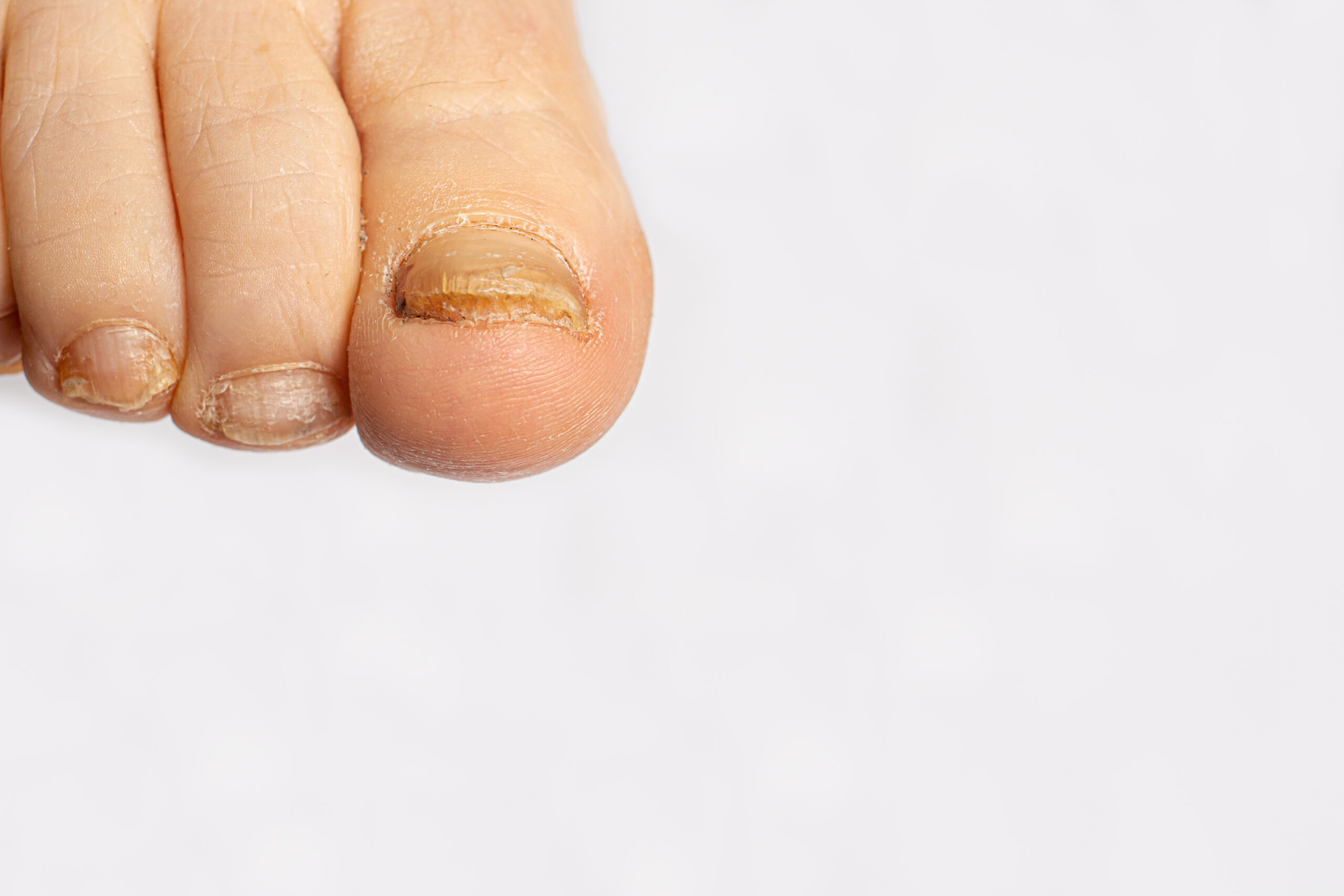 Onicomicose: Micose nas Unhas, Causas, Sintomas e Tratamento