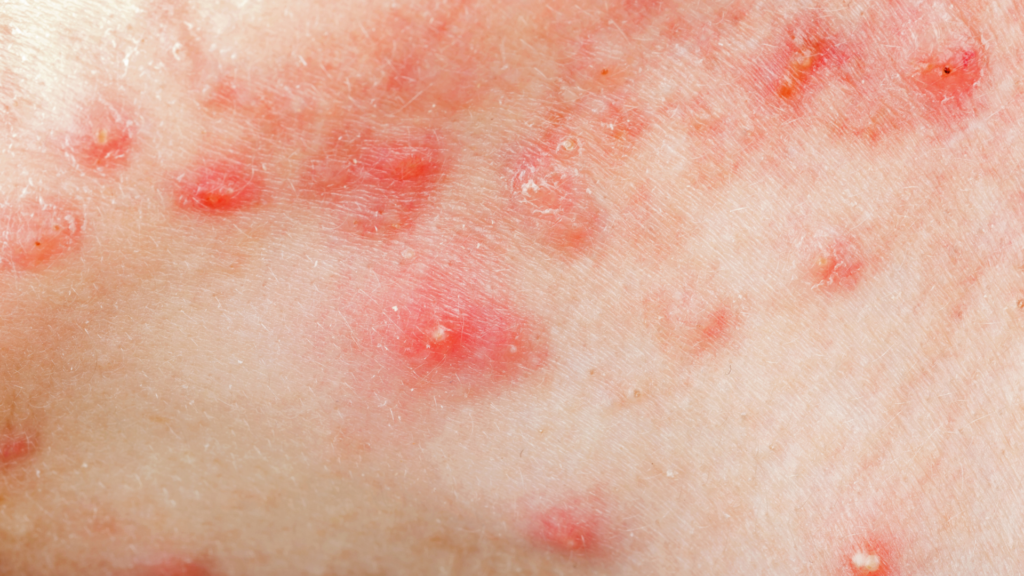 Acne Cística | Dra. Raisa Resende